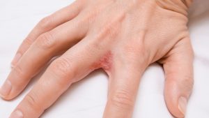 Dyshidrotic Eczema Small Bumps On Hands