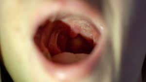 best over the counter medicine for sore throat