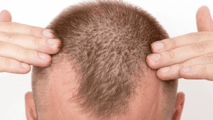 Hair Loss Statistics 2023: Percentage Of Bald Males By Country